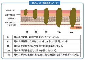 胃がんの診断と治療 | 消化器外科 | 診療科・部門 | 【公式】高槻赤十字病院