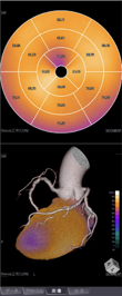負荷時(左)に前壁の心筋に血流の低下(紫色の領域)を認めるが、安静時(右)には血流は回復しており(赤色の領域)、前壁を栄養する冠動脈狭窄による虚血が強く疑われる。