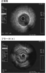 IVUSによる冠動脈の評価(赤点線で囲んだ部分がプラーク)