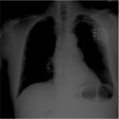 ペースメーカー植込み後の胸部レントゲン