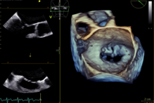 経食道心エコーで観察した僧帽弁閉鎖不全症