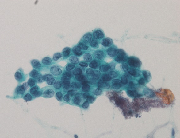 喀痰細胞診で認められた癌細胞 