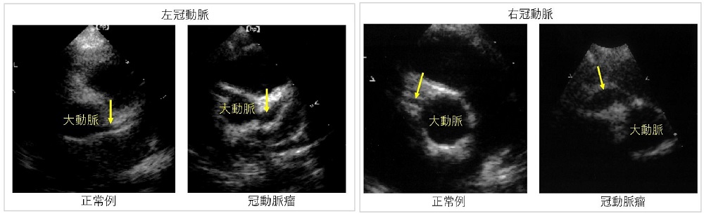 先天性心疾患は、新生児期・乳児期に治療介入が必要な疾患から、治療介入なしで経過を見ることが可能な疾患まで様々です。 適切な診断と治療方針をしっかりと立てて、外科治療が必要な場合は、長年ともに診療に携わってきた大阪医科薬科大学と連携して診療を行っております。 先天性心疾患は術後もその大多数が生涯にわたるフォローが必要とされており、思春期、成人期に達する先天性心疾患患者が増加しており、 成人に達する先天性心疾患患者数はすでに20歳未満の患児数を凌駕しています。 当院でもこのような方々も対象に循環器内科と連携して移行期医療を進めてまいります。
川崎病は1歳前後の乳幼児が罹患する急性熱性疾患で冠動脈に動脈瘤などの病変を合併することがあり、急性期には入院にてガンマグロブリン静注療法などの 治療が必要となり、心エコーによる冠動脈病変の経時的な評価が必要です。